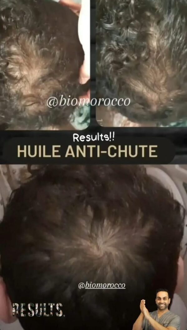 Huile De Moutarde Pour Cheveux - 30 Ml, Stimulation Croissance, Antipelliculaire, Neuf